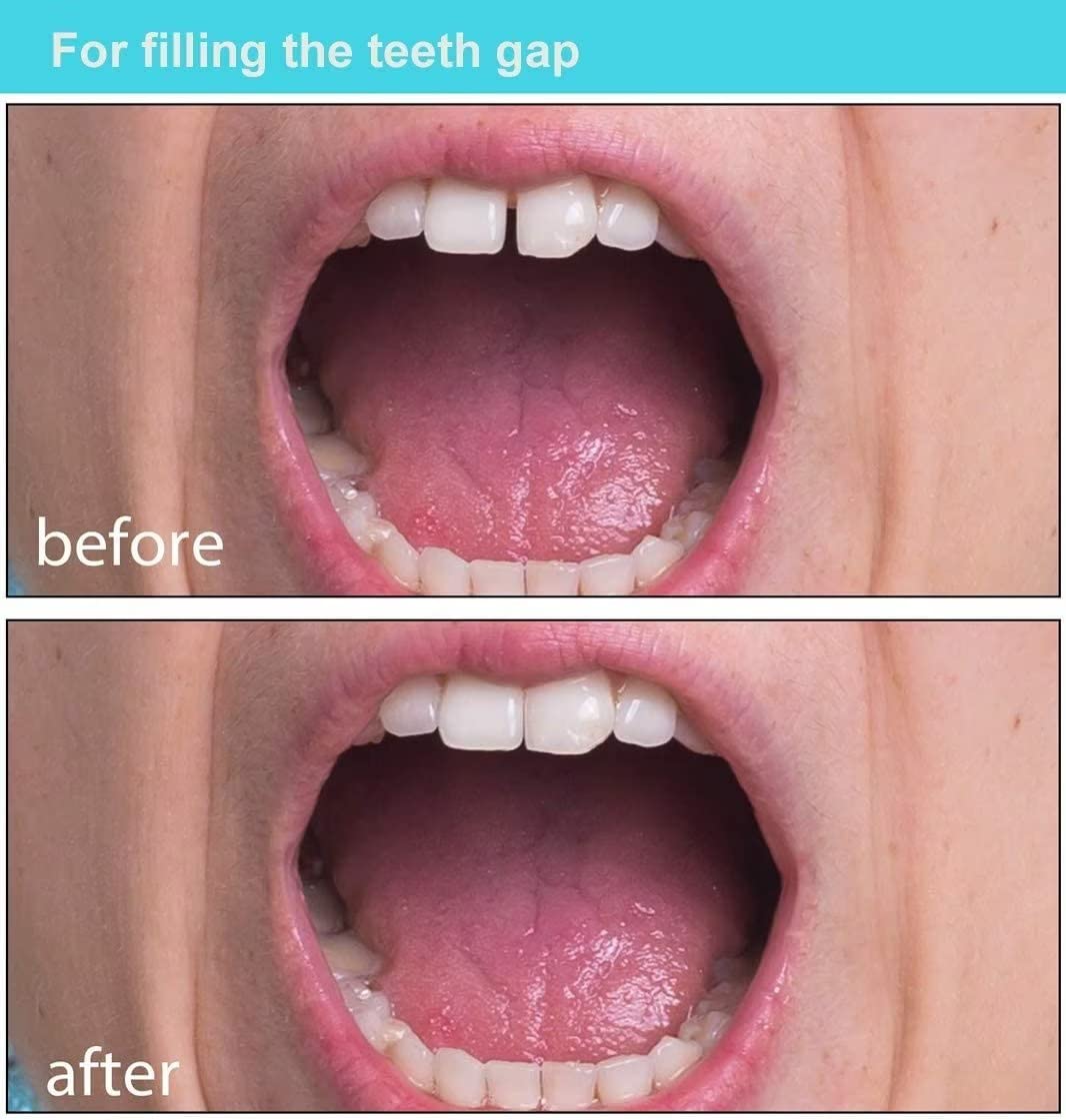 Womcare dent artificielle remplissage couronnes et ponts.