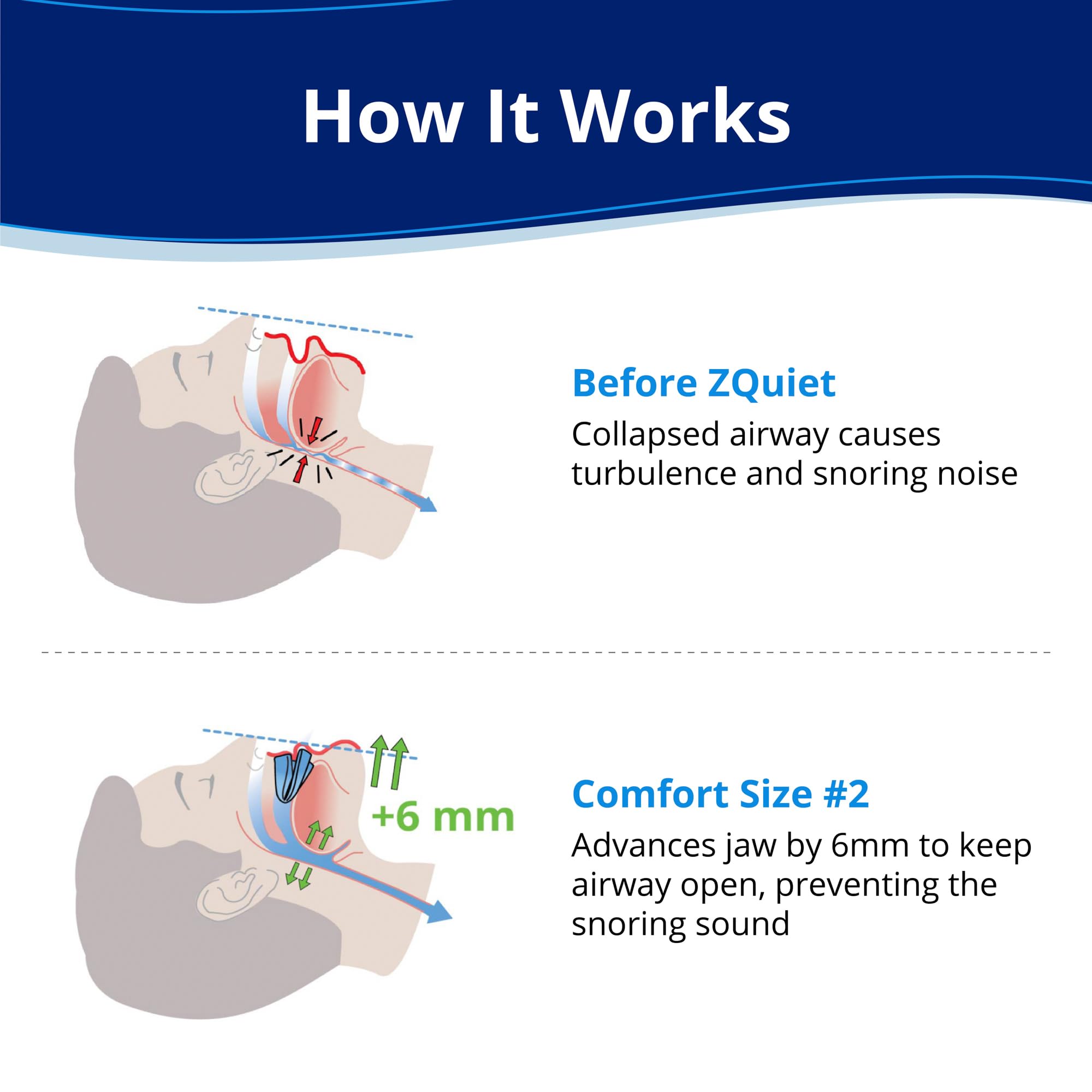 ZQuiet : avance mandible 6mm pour ouvrir les voies aériennes pendant le sommeil.