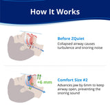 ZQuiet : avance mandible 6mm pour ouvrir les voies aériennes pendant le sommeil.