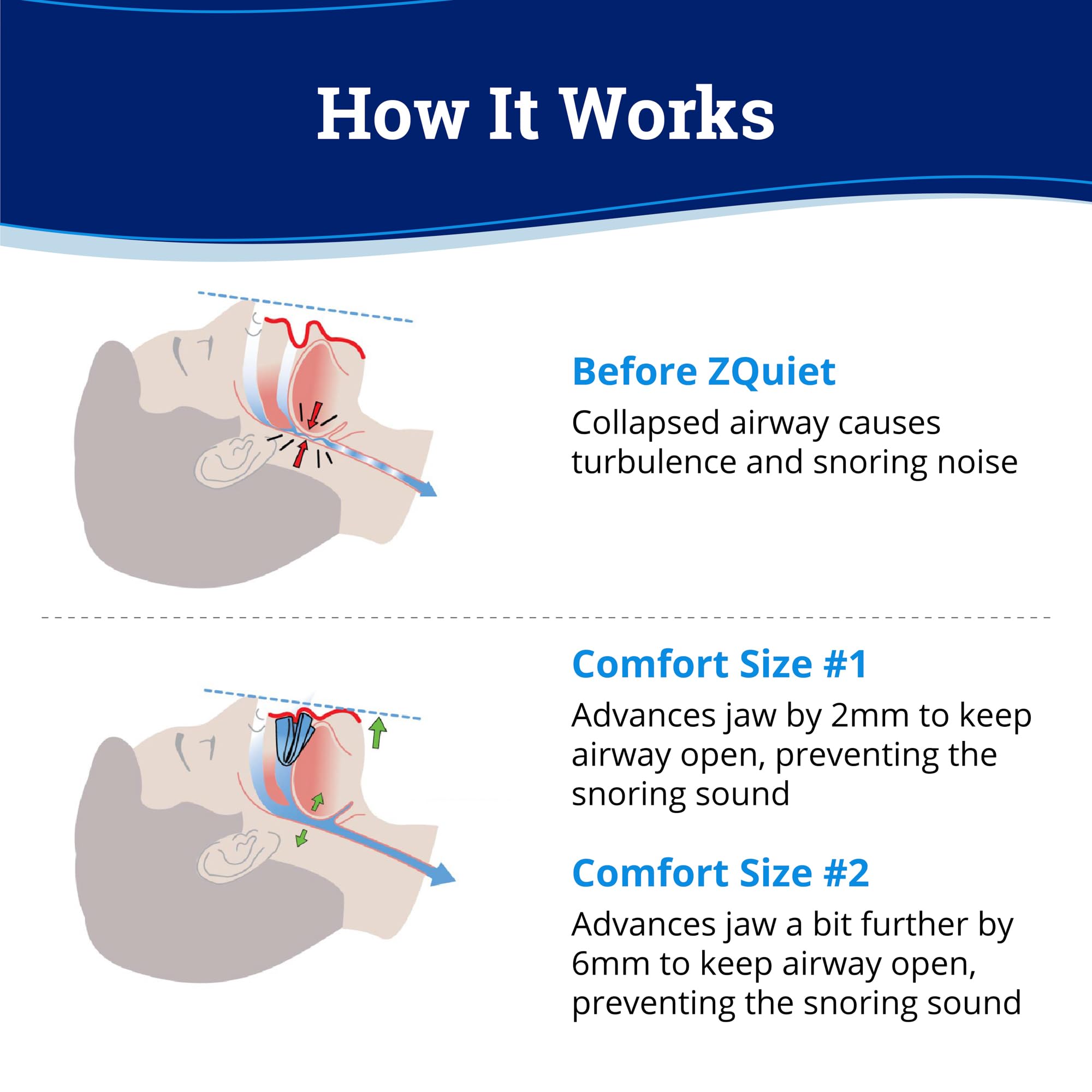 Gouttière ZQuiet confort taille 2 – solution plus ajustée